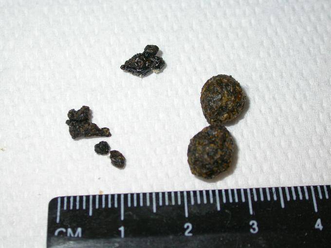 Стеаторея — избыточный жир в кале