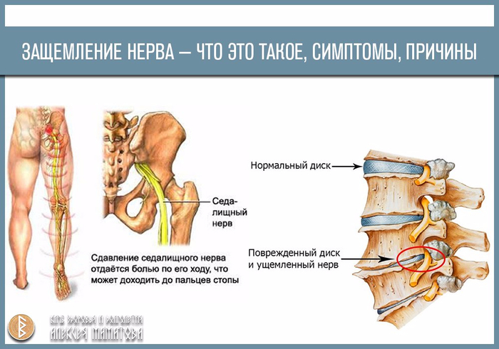 Синдром грушевидной мышцы. способы лечения. | центр дикуля