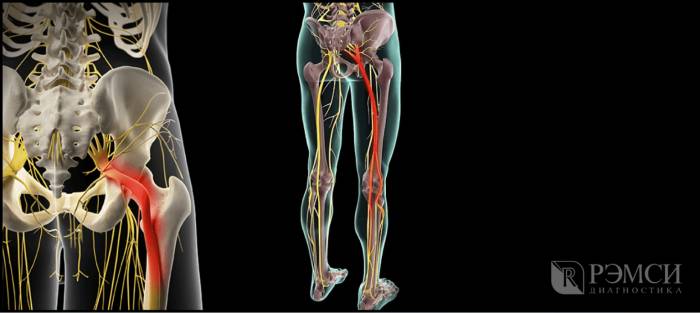 Мануальная терапия при защемлении седалищного нерва