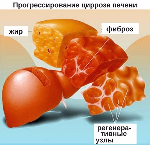 Цирроз печени: симптомы, диагностика | университетская клиника